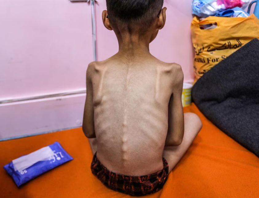 desnutricion infantil en gaza desnutricion infantil en gaza