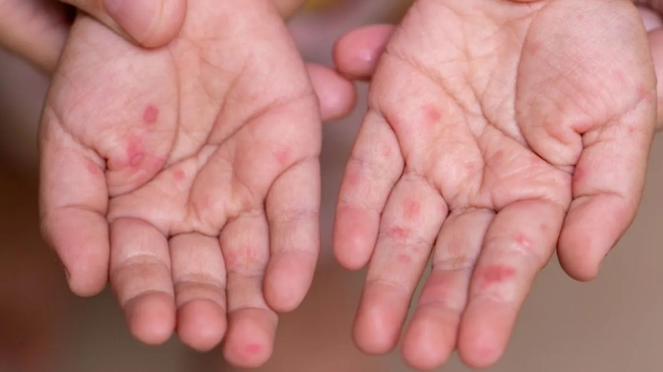 Virus manos, pies y boca: causas, síntomas y como prevenir el contagio
